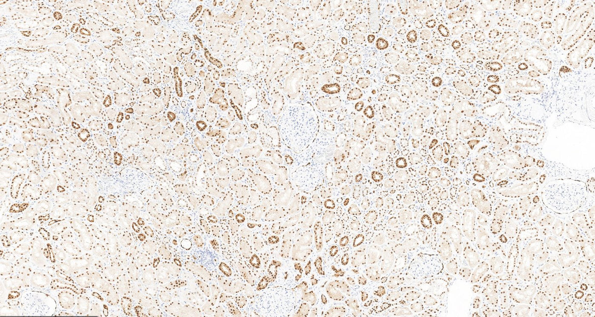 Marquage immunohistochimique anti-Pax-8 — Dartmon