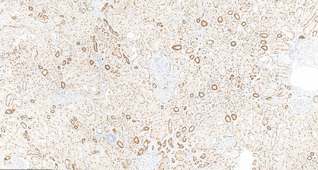 Marquage immunohistochimique anti-Pax-8 — Dartmon