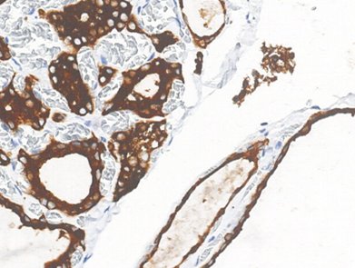 Marquage immunohistochimique anti-TPO — Dartmon