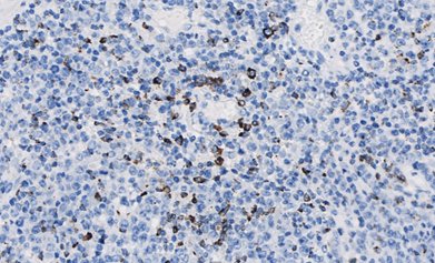 Marquage immunohistochimique anti-Granzyme B — Dartmon