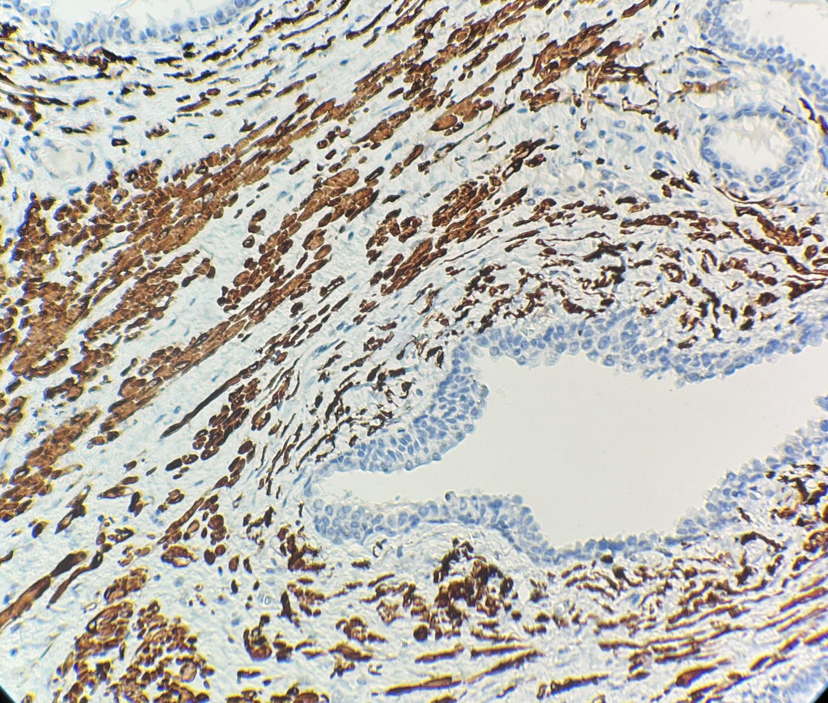 Marquage immunohistochimique anti-Calponin — Dartmon