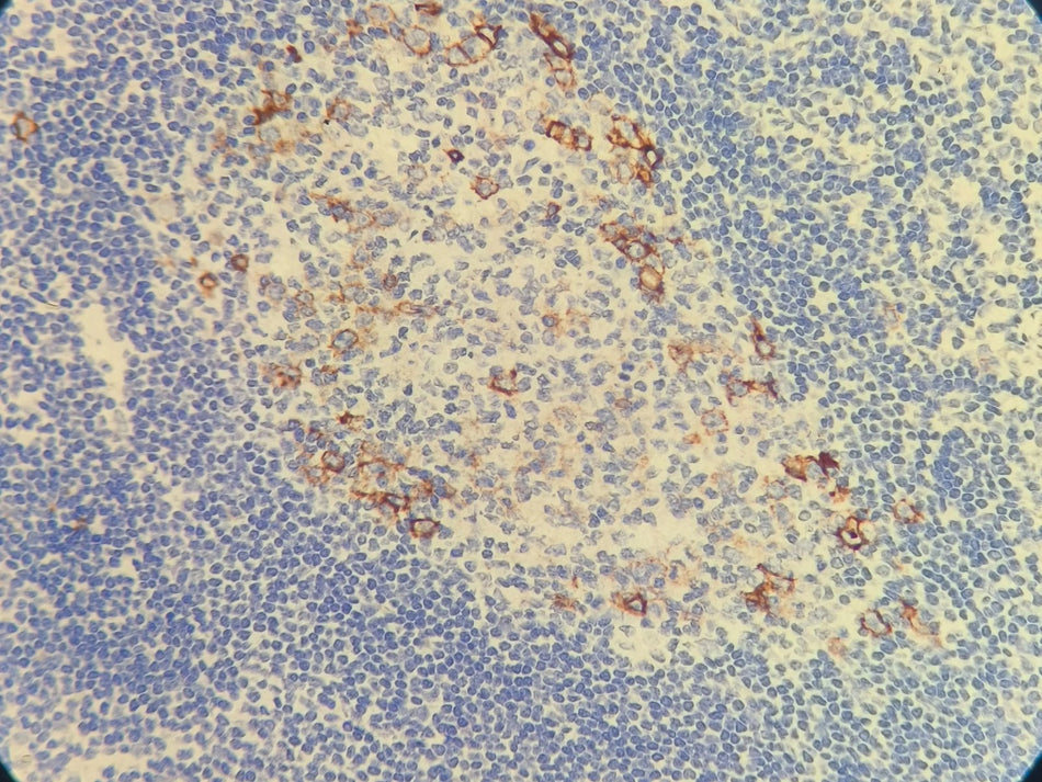 Marquage immunohistochimique anti-CD30 — Dartmon