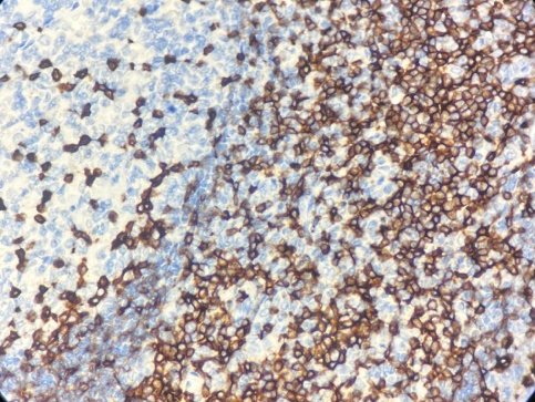Marquage immunohistochimique anti-CD5 — Dartmon