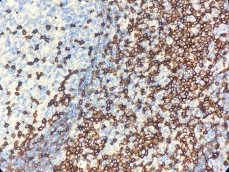Marquage immunohistochimique anti-CD5 — Dartmon