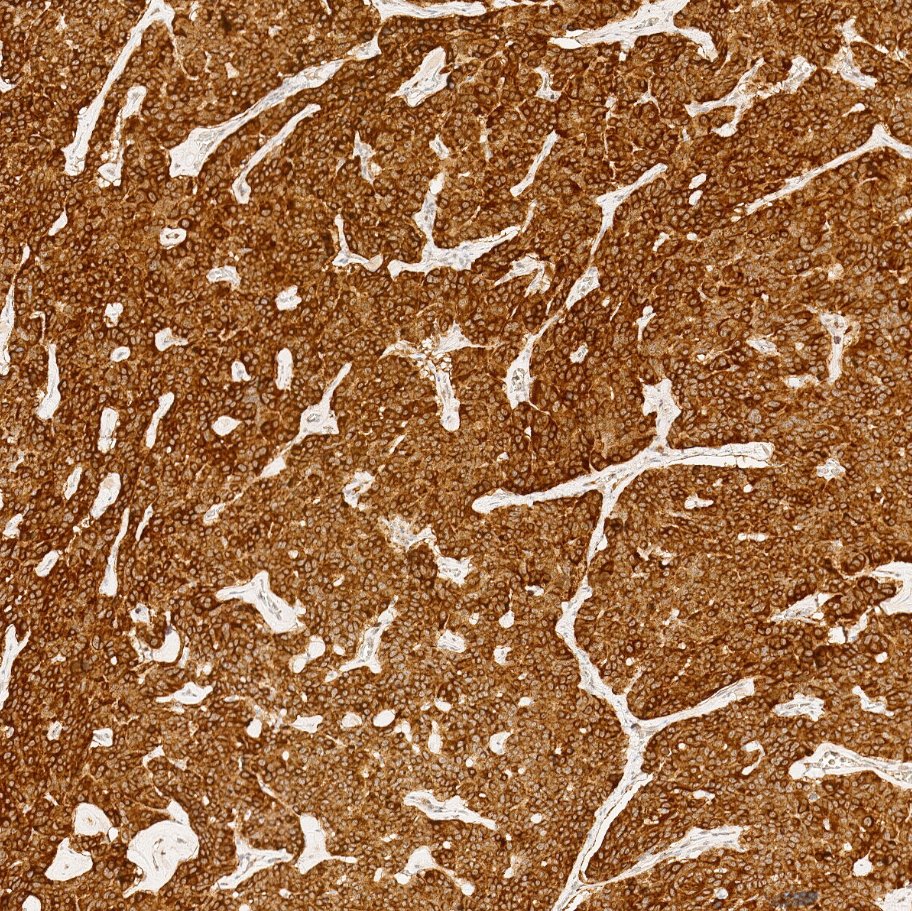 Marquage immunohistochimique anti-CGA — Dartmon