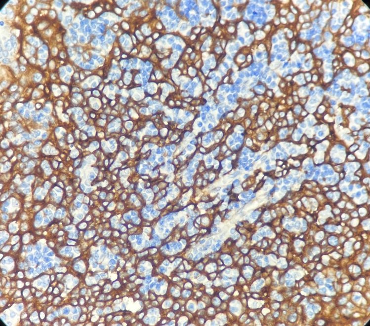 Marquage immunohistochimique anti-EGFR — Dartmon