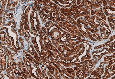Marquage immunohistochimique anti-Gal-3 — Dartmon