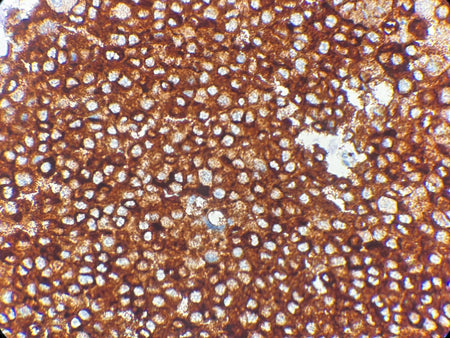 Marquage immunohistochimique anti-MART-1 / Melan-A — Dartmon