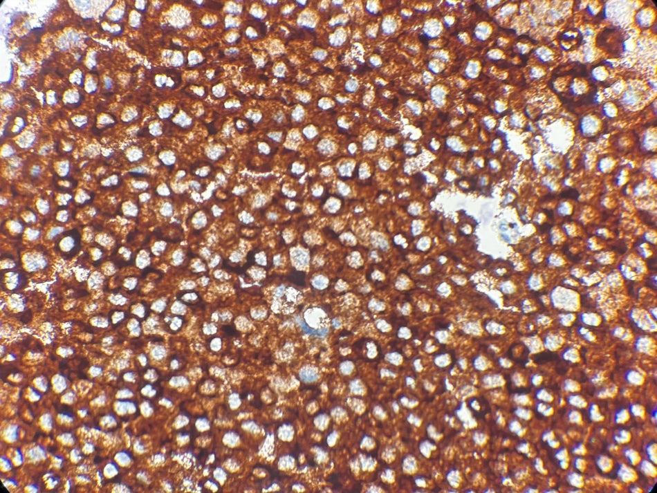 Marquage immunohistochimique anti-MART-1 / Melan-A — Dartmon