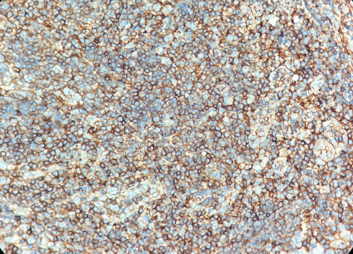 Marquage immunohistochimique anti-CD99 — Dartmon