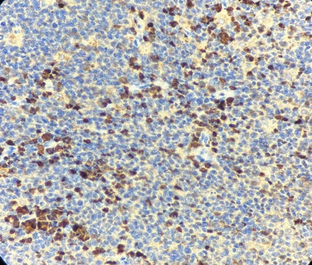 Marquage immunohistochimique anti-MUM1 — Dartmon