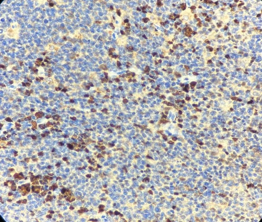 Marquage immunohistochimique anti-MUM1 — Dartmon