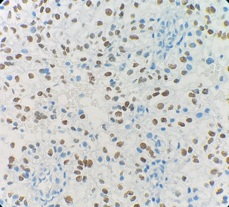 Marquage immunohistochimique anti-TFE3 — Dartmon