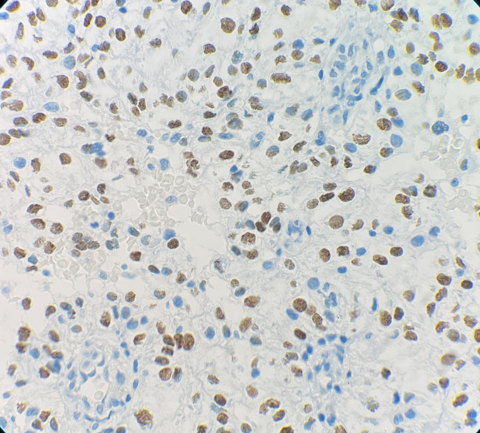 Marquage immunohistochimique anti-TFE3 — Dartmon