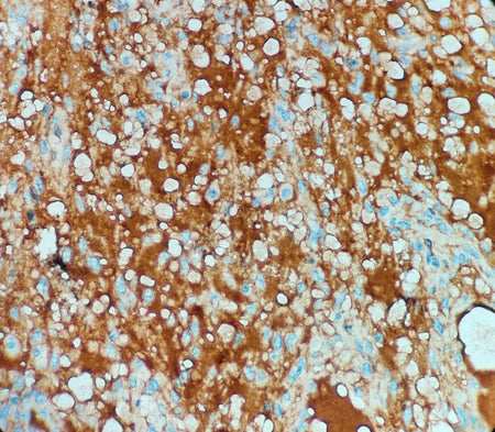 Marquage immunohistochimique anti-AFP — Dartmon
