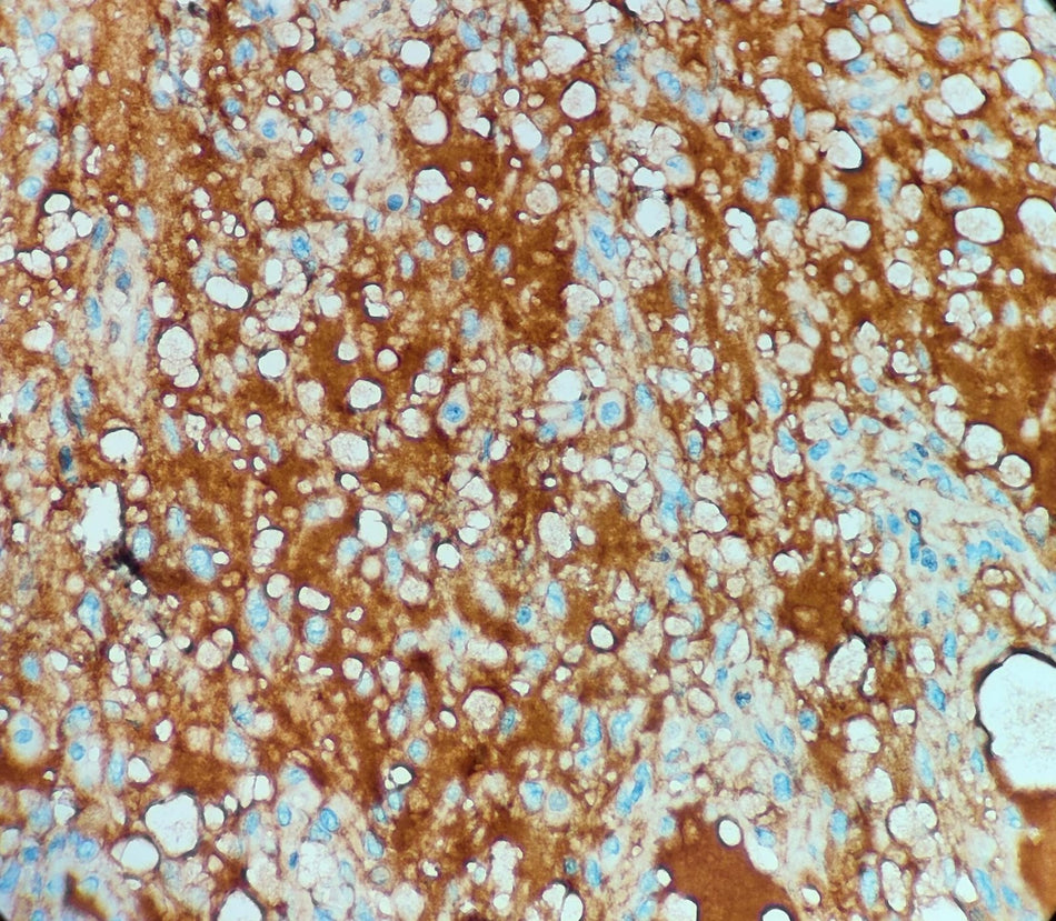 Marquage immunohistochimique anti-AFP — Dartmon