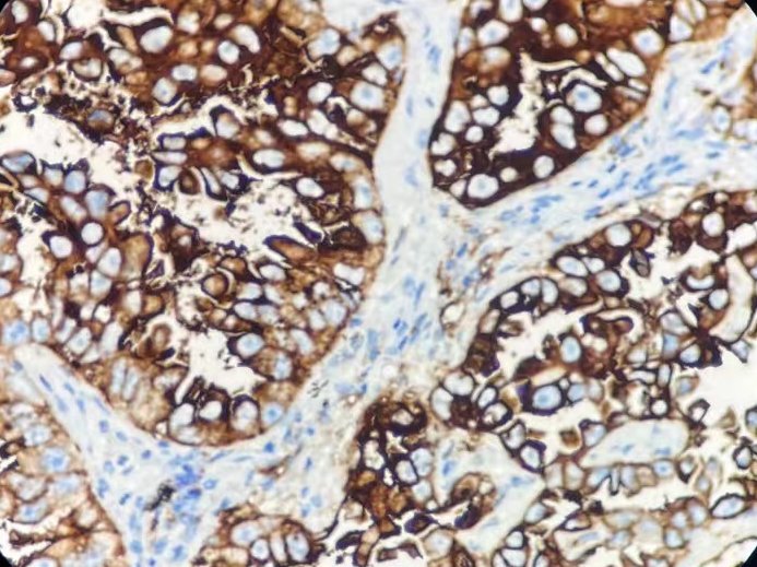 Marquage immunohistochimique anti-CEA — Dartmon